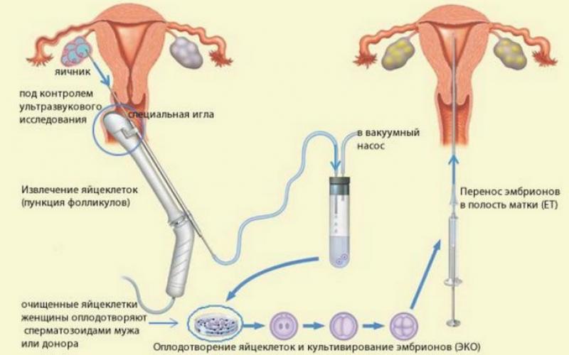 Punkce folikulu během IVF