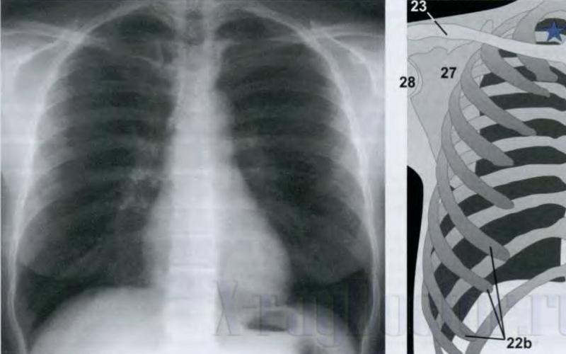 The strangest x-rays