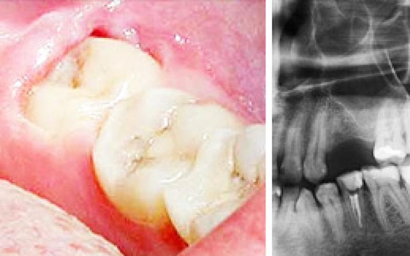 Removing or treating a diseased wisdom tooth